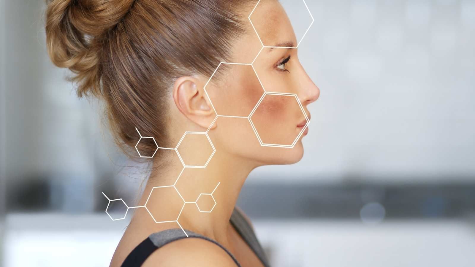 how to deal with hyperpigmentation